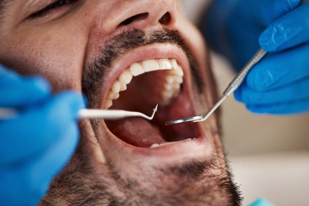 Best Chipped Tooth Repair Near Me  in Moraine, OH